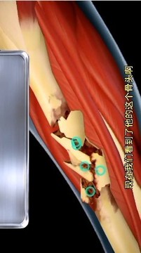 骨折手術(shù)游戲截圖1