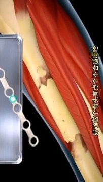 骨折手術(shù)游戲截圖4