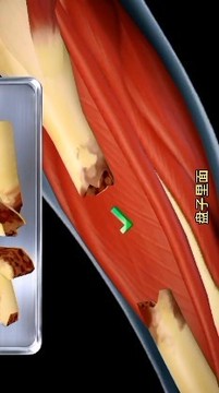 骨折手術(shù)游戲截圖2