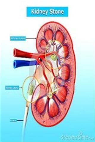删除肾结石指南截图1