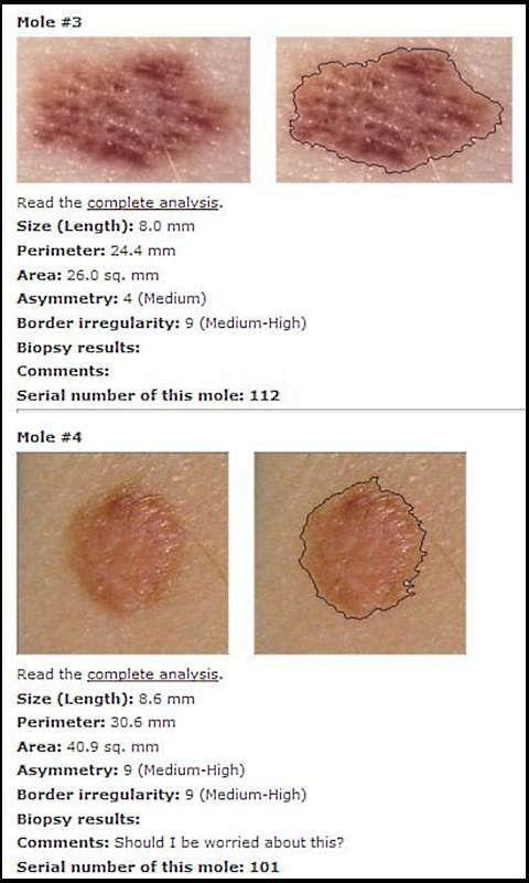 Skin Mole Analysis截图2