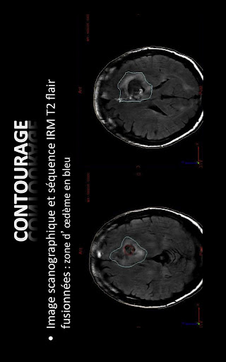 Siriade ORL, Neuro et Sarcome截图5