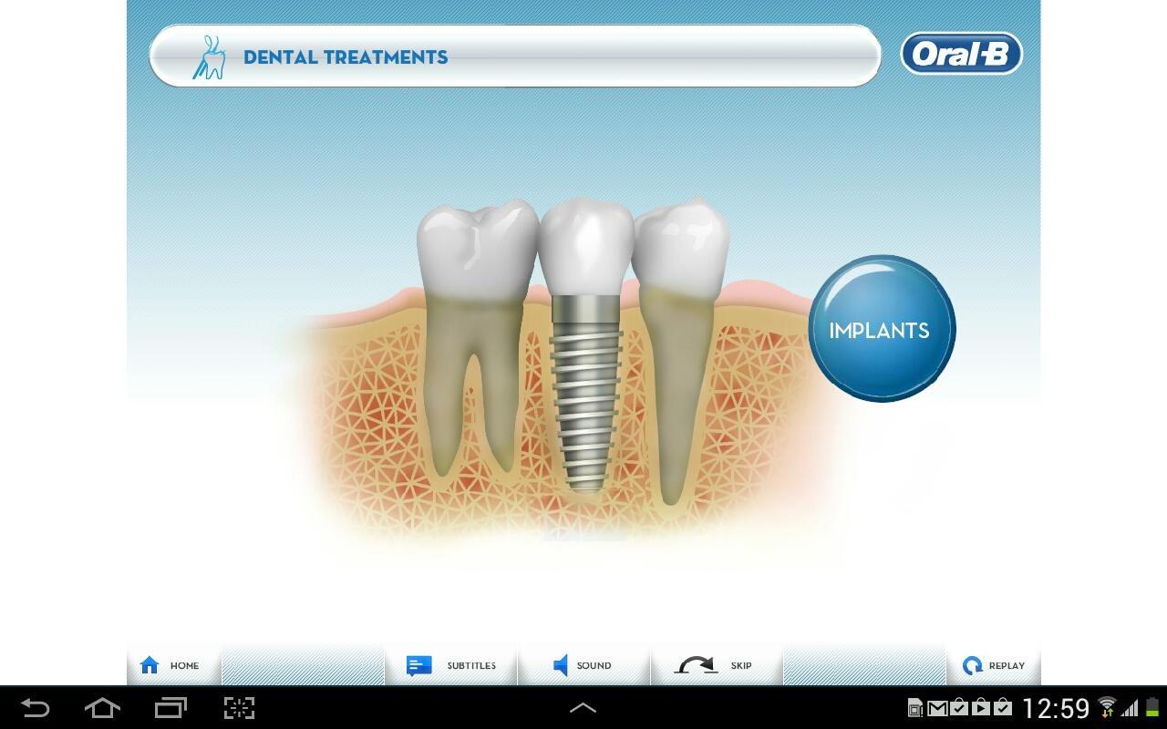 Dental Implants - by Oral-B截图2