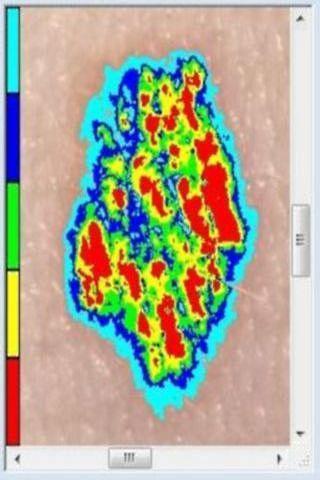 Skin Mole Analysis截图1