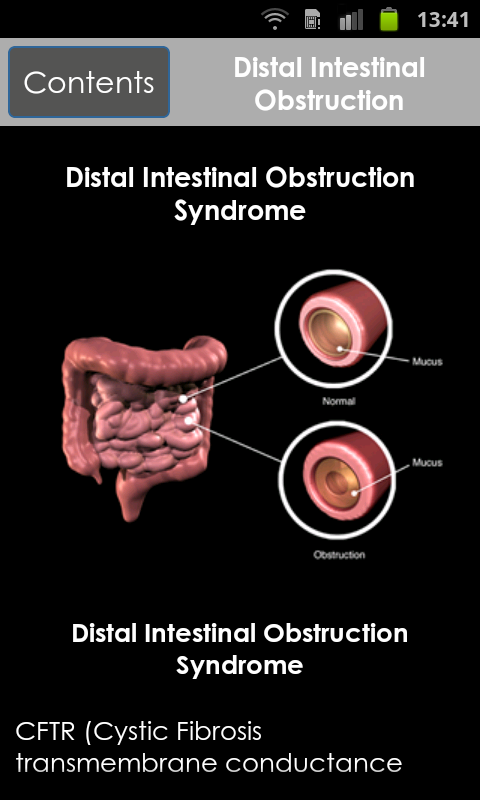 Cystic Fibrosis:A Pocket...截图6