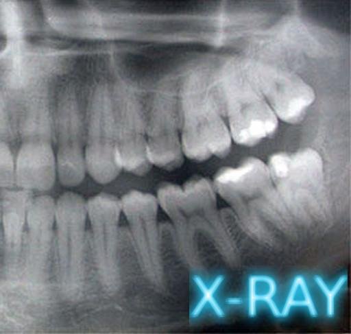 牙科X射线截图1
