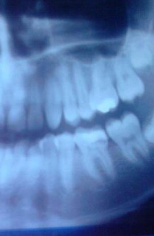 牙科X射线截图2