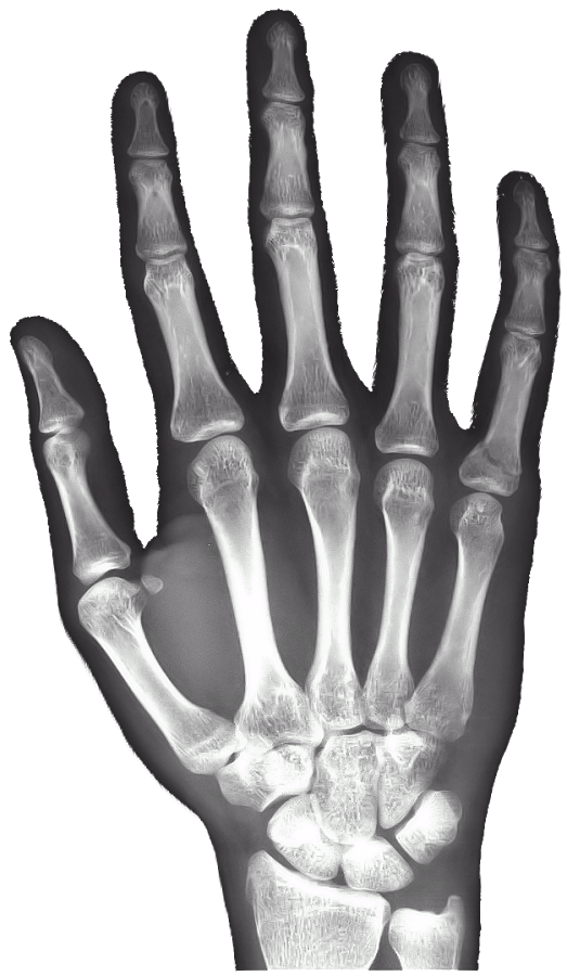 X射线右手免费截图2