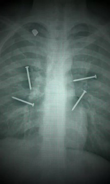 X光肺部扫描仪截图