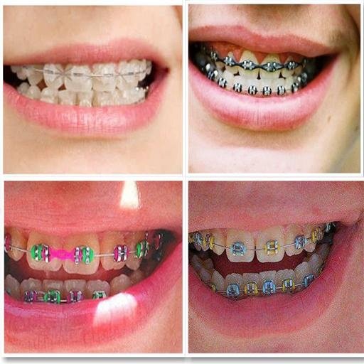 How to Make Fake Braces截图3