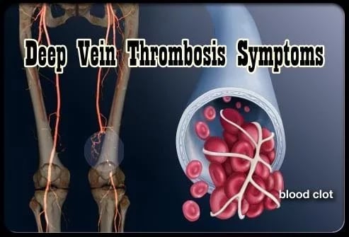 Deep Vein Thrombosis Sym...截图2