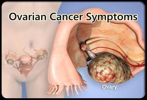 Ovarian Cancer Symptoms截图4