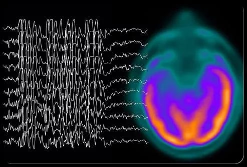 Epilepsy Symptoms截图3