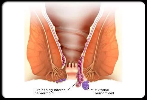 Hemorrhoids Symptoms Tre...截图3