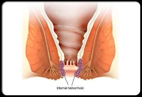 Hemorrhoids Symptoms Tre...截图5