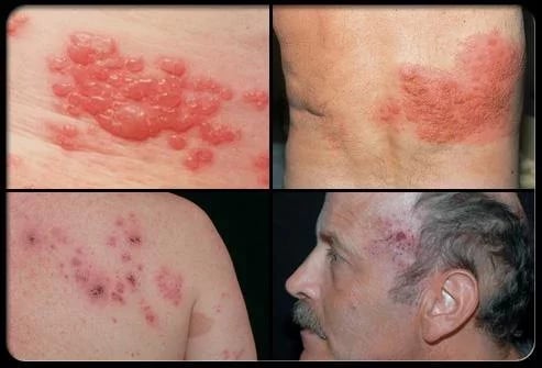 Shingles Symptoms Treatm...截图4