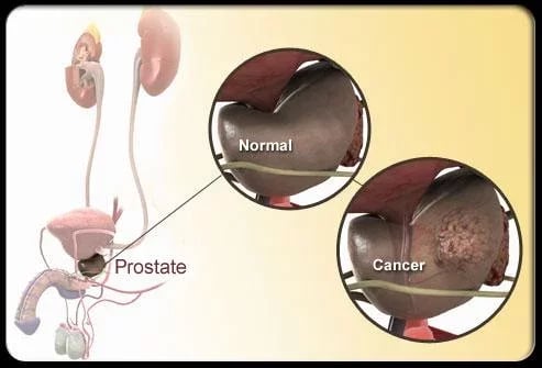 Prostate Cancer Symptoms截图4