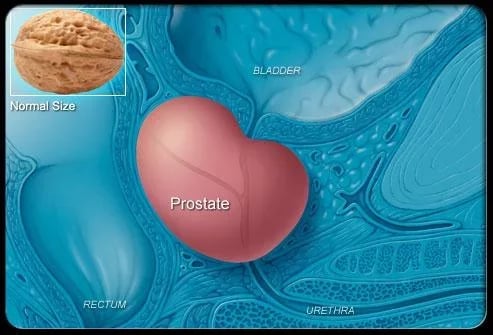 Prostate Cancer Symptoms截图5