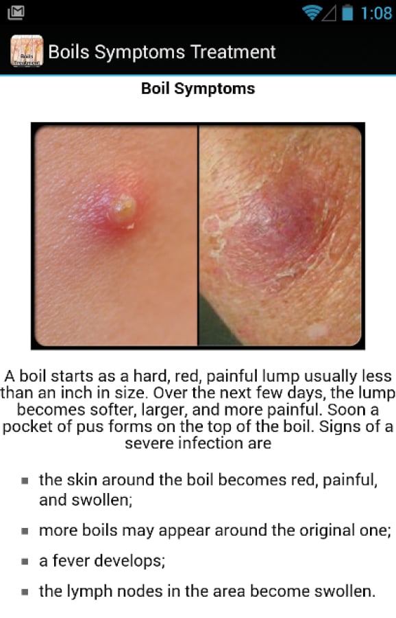 What Causes A Boil On Inner Thigh at Pedro Casale blog