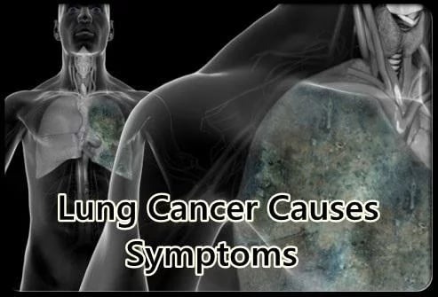 Lung Cancer Causes Sympt...截图5