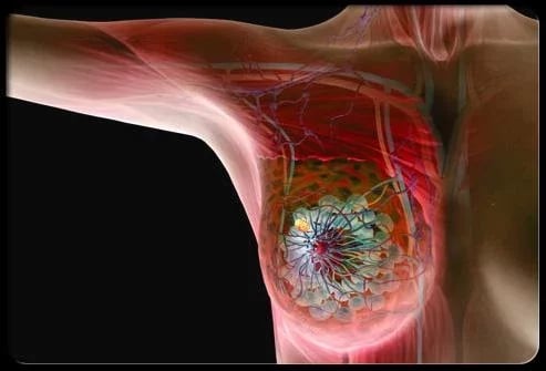 Symptoms of Breast Cance...截图2