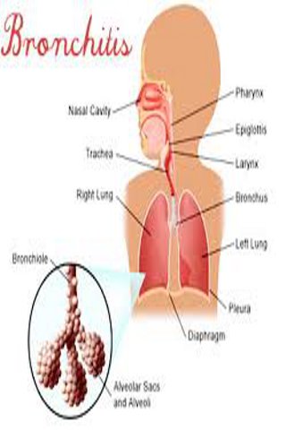 Bronchitis Guide截图3