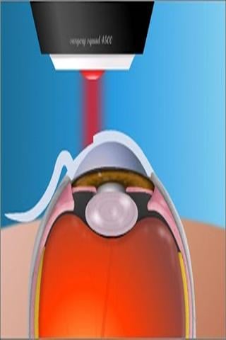 虚拟眼科手术截图2