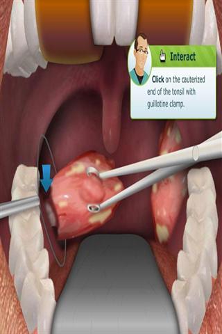 扁桃体切除手术截图2