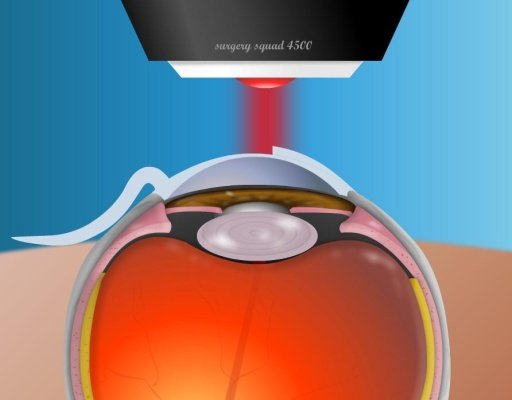 Virtual LASIK Eye Surgery截图2