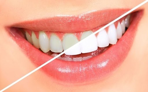 Teeth Whitening Secret Guide 2截图3