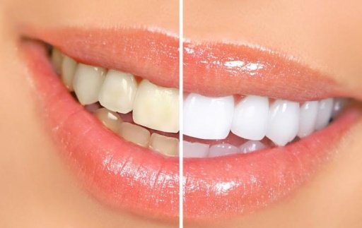 How to Get White Teeth截图3