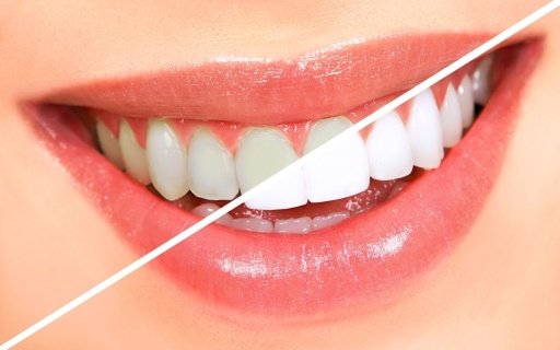 Teeth Whitening Secret Guide 2截图4