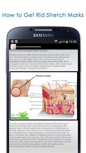 How to Get Rid Stretch Marks截图4