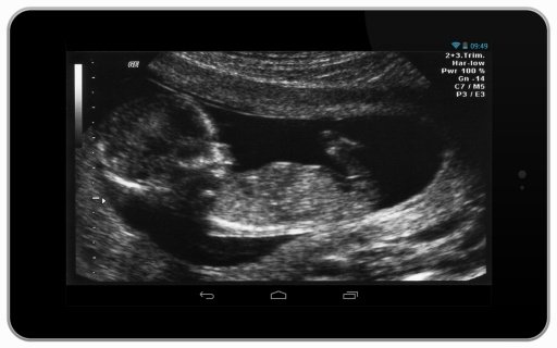 Ultrasound Pregnancy Scanner!截图1