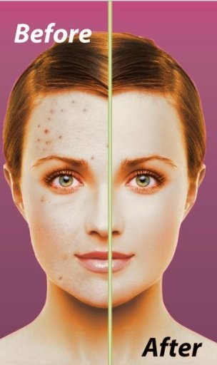 Instant Acne Remover截图3