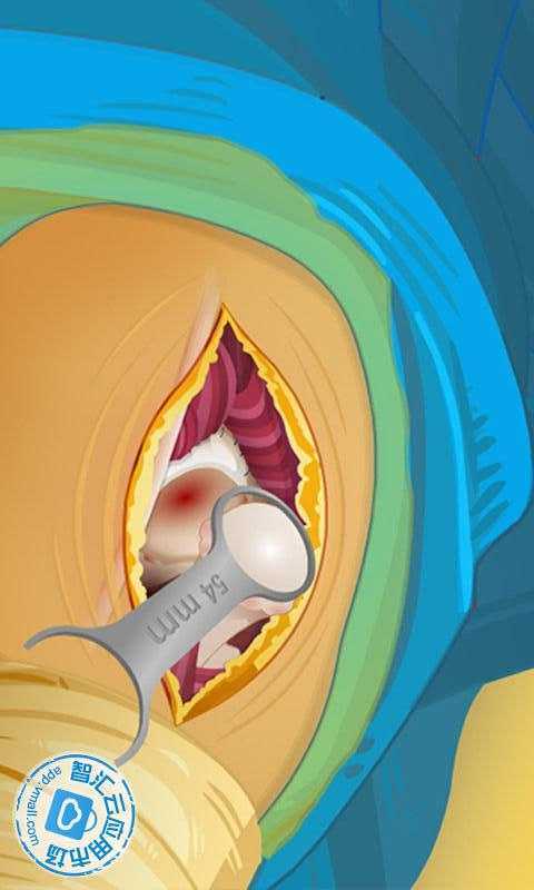 Virtual Hip Surgery截图4