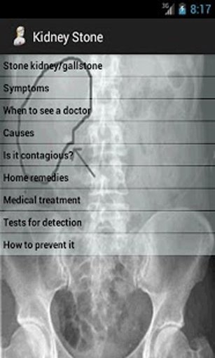 肾结石 Kidney Stone截图4