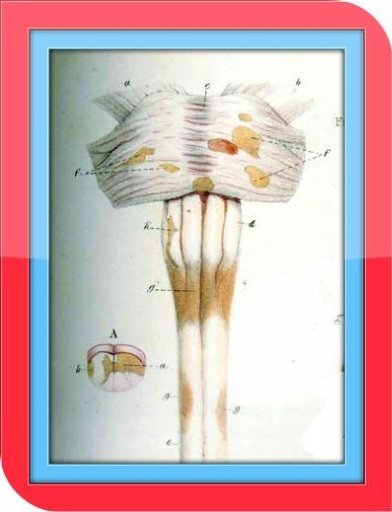 Multiple Sclerosis Symptoms截图5