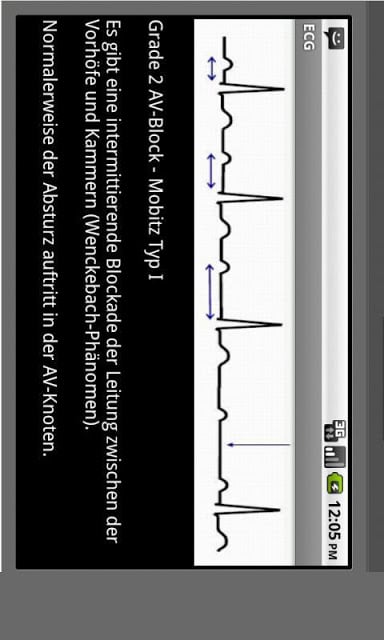 Elektrokardiogramm EKG Typen截图5