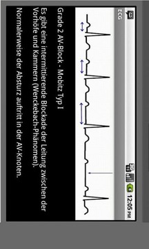 Elektrokardiogramm EKG Typen截图