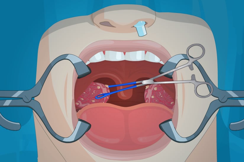 Operate Now Tonsil Surgery截图1