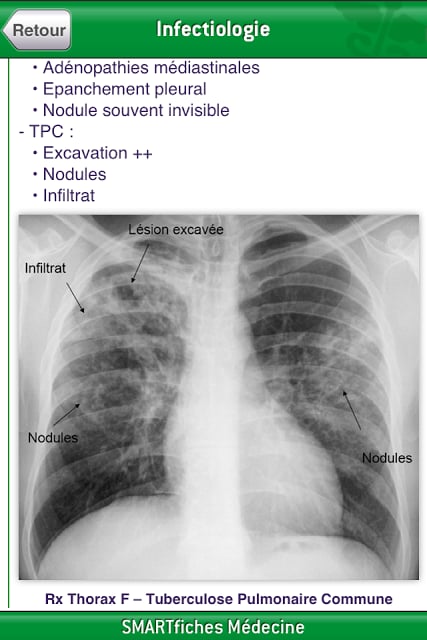 SMARTfiches Infectiologie Free截图11