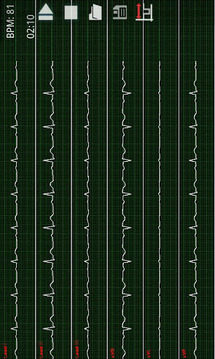 ABI-ECG截图
