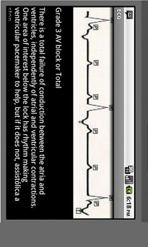 Electrocardiogram ECG Types截图