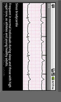 Electrocardiogram ECG Types截图