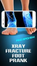 Xray Fracture Foot Prank截图1