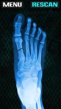 Xray Fracture Foot Prank截图2